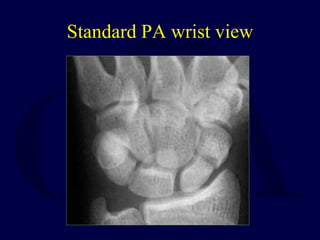 Standard PA wrist view
 