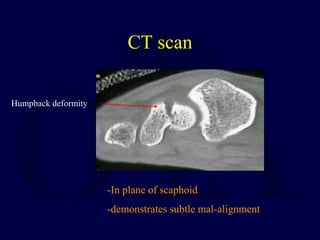 CT scan
-In plane of scaphoid
-demonstrates subtle mal-alignment
Humpback deformity
 