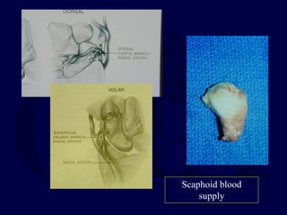 Scaphoid blood
supply
 