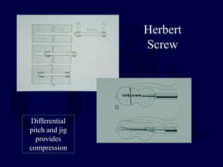 Herbert
Screw
Differential
pitch and jig
provides
compression
 