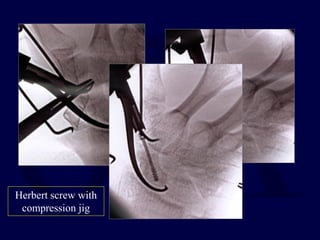 Herbert screw with
compression jig
 
