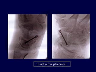 Final screw placement
 