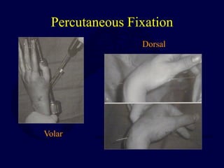 Percutaneous Fixation
Volar
Dorsal
 