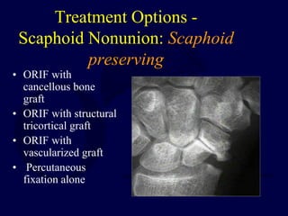 Treatment Options -
Scaphoid Nonunion: Scaphoid
preserving
• ORIF with
cancellous bone
graft
• ORIF with structural
tricortical graft
• ORIF with
vascularized graft
• Percutaneous
fixation alone
 