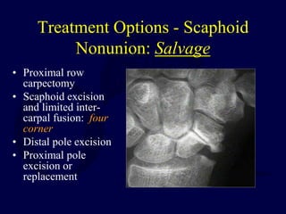 Treatment Options - Scaphoid
Nonunion: Salvage
• Proximal row
carpectomy
• Scaphoid excision
and limited inter-
carpal fusion: four
corner
• Distal pole excision
• Proximal pole
excision or
replacement
 