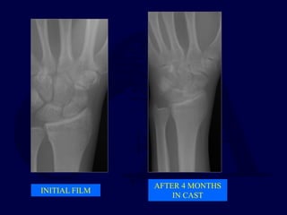 INITIAL FILM
AFTER 4 MONTHS
IN CAST
 
