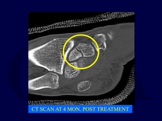 CT SCAN AT 4 MON. POST TREATMENT
 