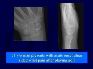 51 y/o man presents with acute onset ulnar
sided wrist pain after playing golf
 