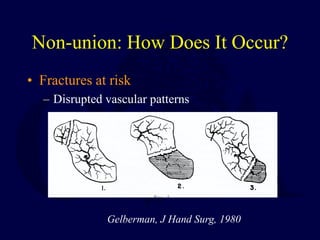 Non-union: How Does It Occur?
• Fractures at risk
– Disrupted vascular patterns
Gelberman, J Hand Surg, 1980
 