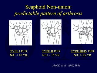 Scaphoid Non-union:
predictable pattern of arthrosis
TYPE I DJD:
N/U < 10 YR.
TYPE II DJD:
N/U ~ 15 YR.
TYPE III/IV DJD:
N/U > 25 YR.
MACK, et al., JBJS, 1984
 
