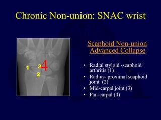 Chronic Non-union: SNAC wrist
Scaphoid Non-union
Advanced Collapse
• Radial styloid -scaphoid
arthritis (1)
• Radius- proximal scaphoid
joint (2)
• Mid-carpal joint (3)
• Pan-carpal (4)
1
2
3
4
 