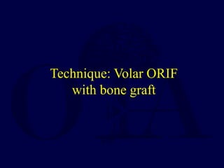 Technique: Volar ORIF
with bone graft
 