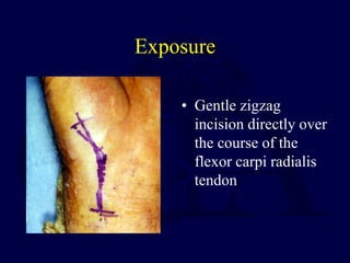 Exposure
• Gentle zigzag
incision directly over
the course of the
flexor carpi radialis
tendon
 
