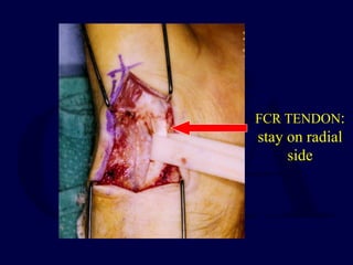 FCR TENDON:
stay on radial
side
 