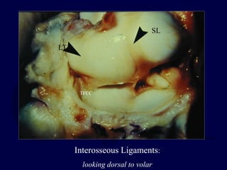 SL
LT
TFCC
Interosseous Ligaments:
looking dorsal to volar
 
