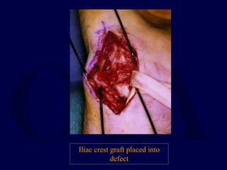 Iliac crest graft placed into
defect
 