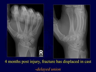 4 months post injury, fracture has displaced in cast
-delayed union
 