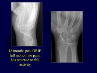 18 months post ORIF,
full motion, no pain,
has returned to full
activity
 