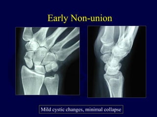 Early Non-union
Mild cystic changes, minimal collapse
 