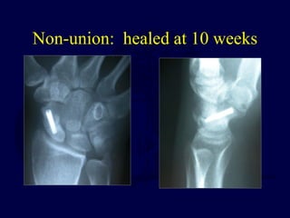 Non-union: healed at 10 weeks
 