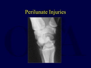 Perilunate Injuries
 