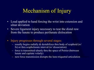 Mechanism of Injury
• Load applied to hand forcing the wrist into extension and
ulnar deviation
• Severe ligament injury necessary to tear the distal row
from the lunate to produce perilunate dislocation
• Injury progresses through several stages:
– usually begins radially & destabilizes thru body of scaphoid (w/
fx) or thru scapholunate interval (w/ dissociation)
– force is transmitted ulnarly thru the space of Poirier (between
lunate and capitate volarly)
– next force transmission disrupts the luno-triquetral articulation
 