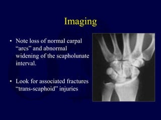 Imaging
• Note loss of normal carpal
“arcs” and abnormal
widening of the scapholunate
interval.
• Look for associated fractures
“trans-scaphoid” injuries
 