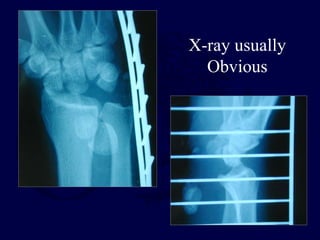 X-ray usually
Obvious
 