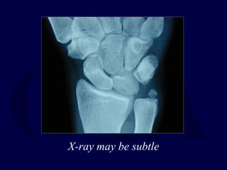 X-ray may be subtle
 