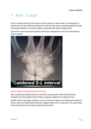 Carpal instability
Version 9
12
7 Red flags
Due to complex geometry of the bones and their overlap on lateral views, the radiographs of
carpal bones are very difficult to evaluate. As such the best means to detecting ligament injuries
and carpal instability is to maintain vigilance, especially with higher-energy trauma.
Loss of the normal symmetrical spaces normal seen radiographs can be a clue that ligament
injury is present.
Figure: widened scapholunate interval is shown
Also, scapholunate ligament tears are commonly associated with distal radius fractures.
Persistent wrist pain despite fracture fixation suggests a diagnosis of a ligament injury.
Sudden onset of neurologic symptoms such as numbness, tingling, and radiating pain along the
thumb, index and middle finger distribution suggest median nerve compression (an acute carpal
tunnel syndrome) and may require urgent decompression.
 