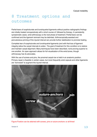 Carpal instability
Version 9
13
8 Treatment options and
outcomes
Partial tears of scapholunate and lunotriquetral ligaments without positive radiographic findings
are initially treated nonoperatively with a short course of, followed by therapy. In persistently
symptomatic cases, wrist arthroscopy is the next phase of treatment. Partial tears can be
confirmed and the ligament remnant may be debrided. Arthroscopically-assisted and
percutaneous pinning of the injured interval can provide further stabilization to promote healing.
Complete tear of scapholunate and lunotriquetral ligaments (and with that loss of ligament
integrity) allow the carpal intervals to widen. The goal of treatment for this condition is to restore
and maintain carpal alignment. Many techniques have been described, none proving superior to
one another. An open approach allows for full visualization of the wrist bones, though
arthroscopy has its advocates.
With the use of screws and pins, the proximal carpal row is held in an anatomic position.
Primary repair is feasible in certain cases, but more frequently wrist capsule and other ligaments
are “borrowed” to augment the injured interval.
Figure Fixation can be attained with screws, pins or suture anchors- or all three!
 