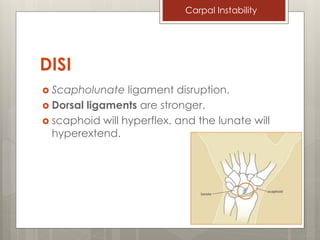 Carpal instability - Orthopedic | PDF