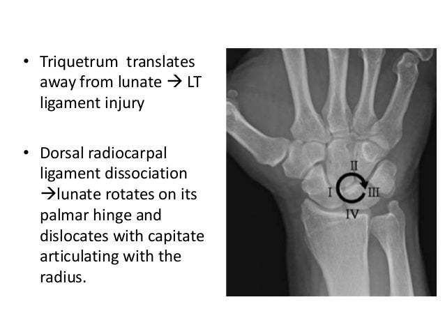 CARPAL INSTABILITY PDF CARPAL INSTABILITY PDF