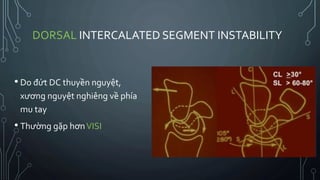 Carpal instability - mất vững khớp cổ tay | PPTX