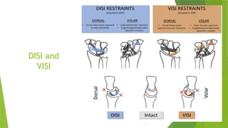 Carpal instability by dr lim wei yuan.ppt