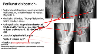 Carpal instability Dr Haki Selaj.pdf QKUK | PDF
