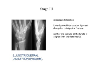 Wrist biomechanics and Carpal_Instability_Presentation-.pptx