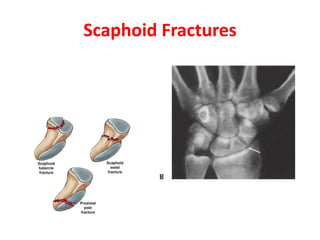 Scaphoid Fractures
 