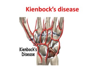 Kienbock’s disease
 