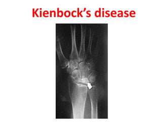 Kienbock’s disease
 