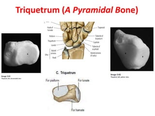 Triquetrum (A Pyramidal Bone)
 