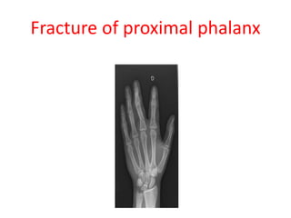 Fracture of proximal phalanx
 