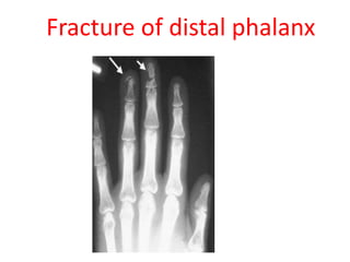 Fracture of distal phalanx
 