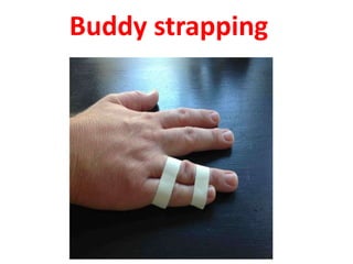 Buddy strapping
 