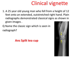 Clinical vignette
1. A 25 year old young man who fell from a height of 12
feet onto an extended, outstretched right hand. Plain
radiographs demonstrated classical signs as shown in
given images .
Q Name the classic sign which is seen in
radiograph?
Ans Spilt tea cup
 
