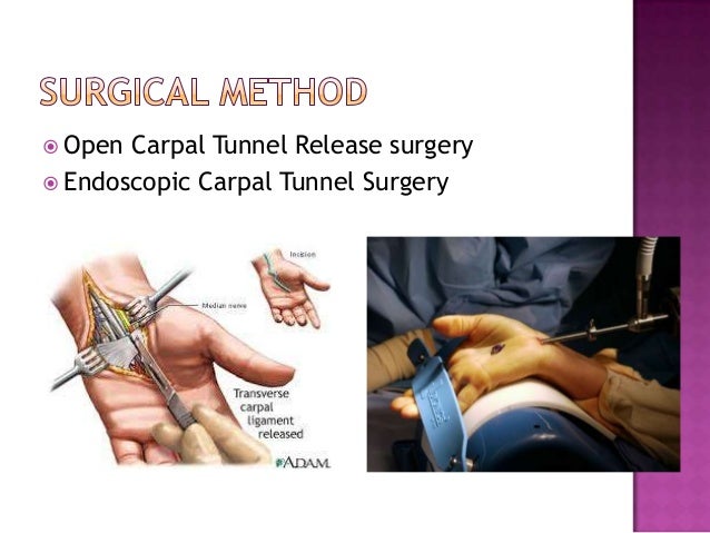 Carpal Tunnel Syndrome The Pros And Cons Of Surgical Vs Conservative