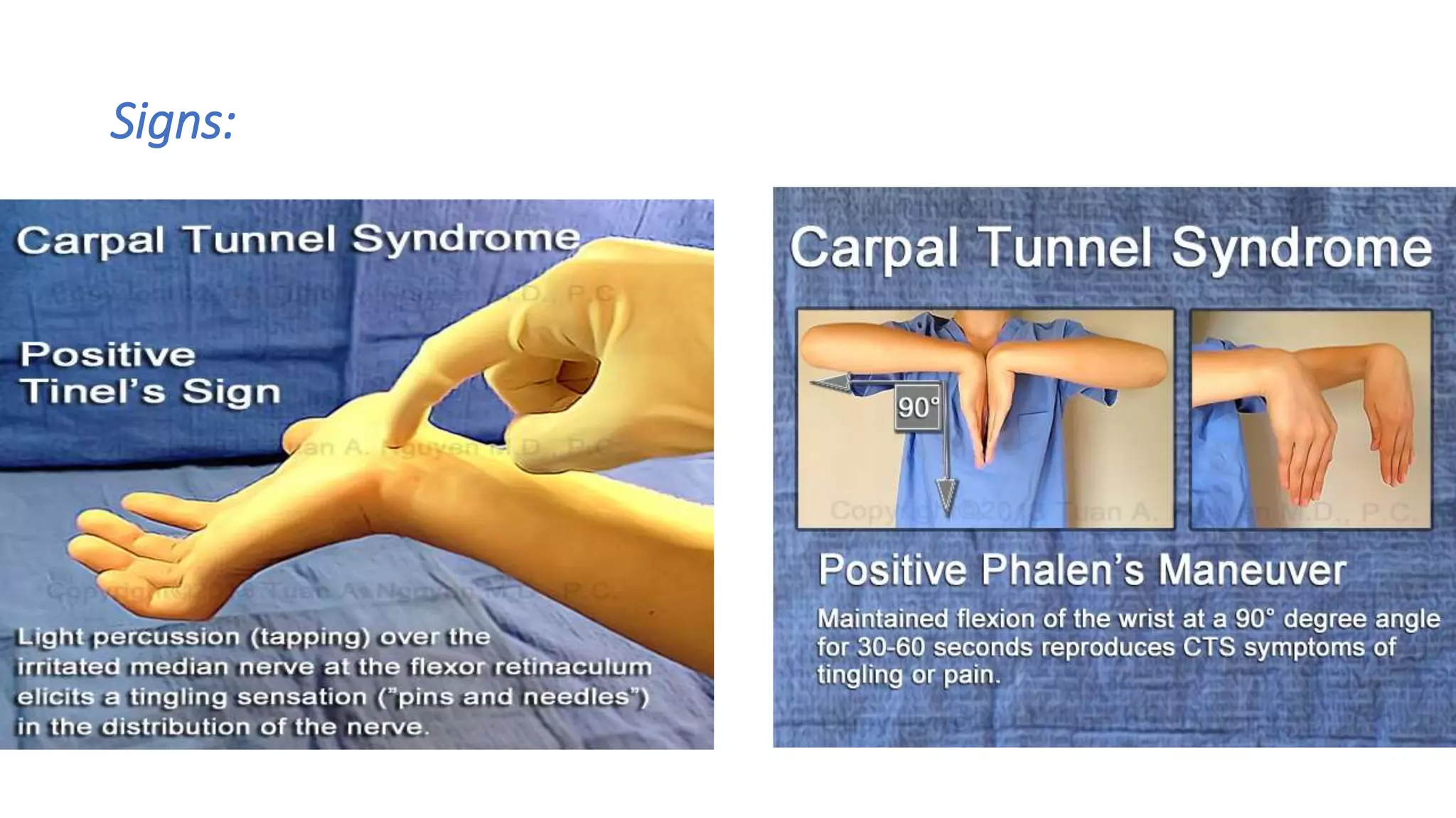 Carpal Tunnel Release