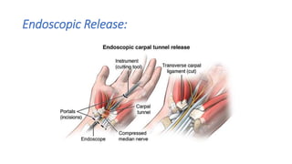 Carpal Tunnel Release | PPTX