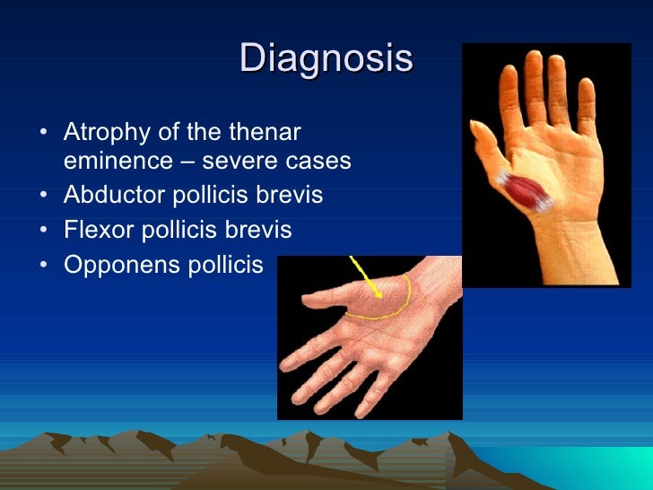 Carpal Tunnel Syndrome