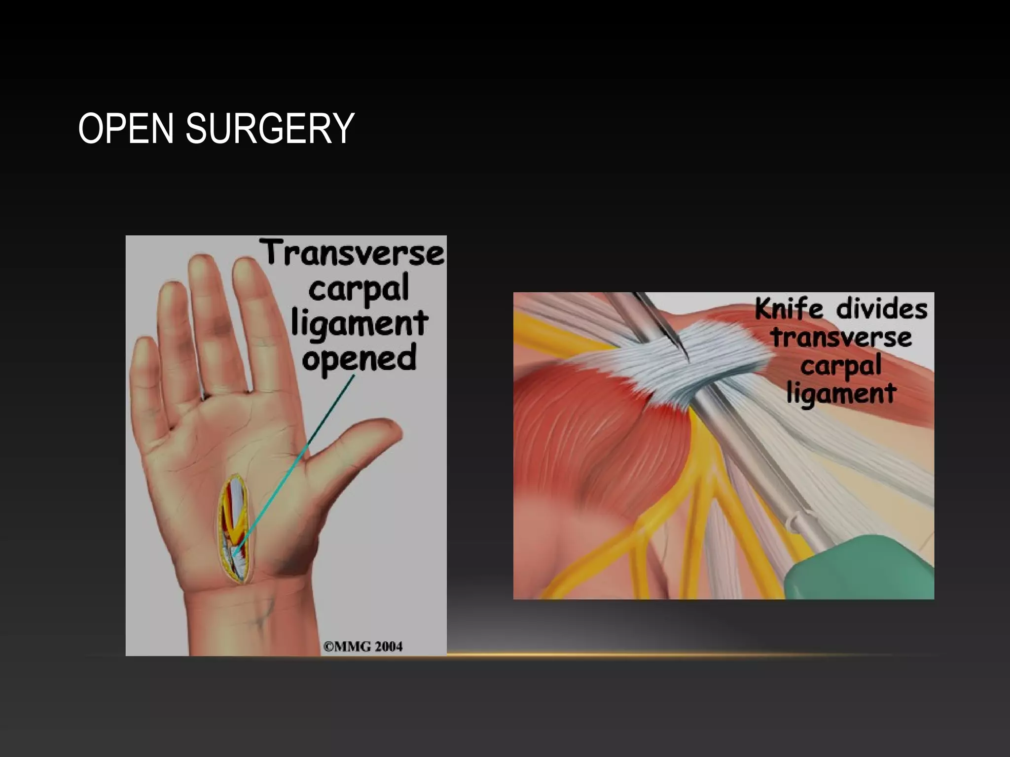 carpal-tunnel-syndrome-ppt